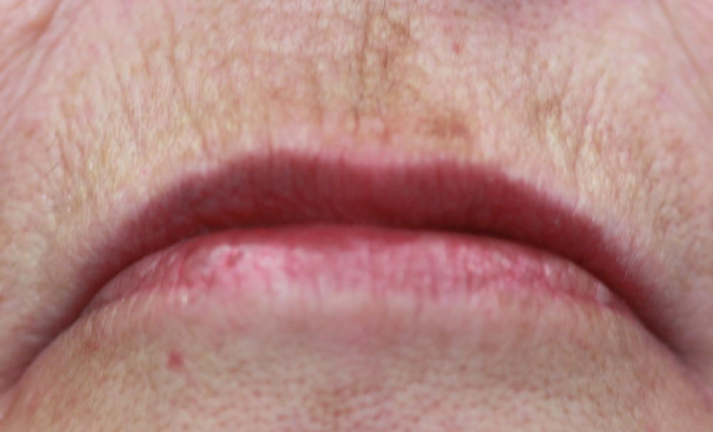 softening-of-vertical-lip-lines-smooth-away-the-years-wrinkle